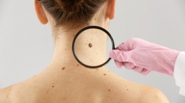 Melanoma: Se diagnostican más de 1600 casos cada año